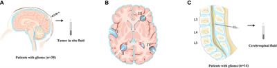 Tumor DNA From Tumor In Situ Fluid Reveals Mutation Landscape of Minimal Residual Disease After <mark class="highlighted">Glioma Surgery</mark> and Risk of Early Recurrence